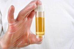 Urinalysis is one of the diagnostic methods for prostatitis