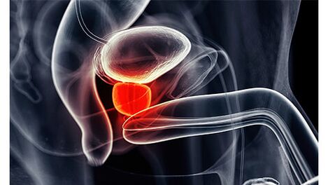 Inflammation of the prostate gland