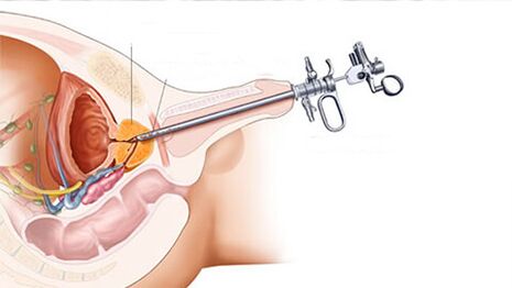 Prostatitis surgical treatment