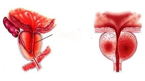 What chronic prostatitis looks like